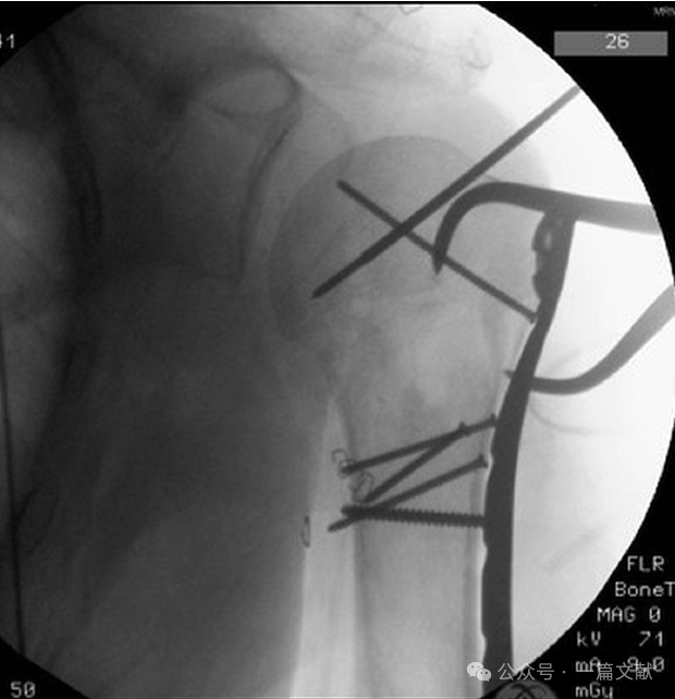 肱骨近端骨折术中透视技巧