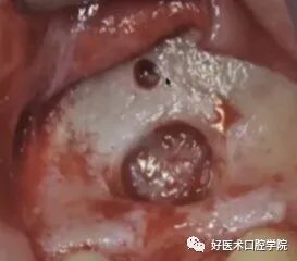 一文读懂与上颌窦提升术相关的上颌窦囊性病变!