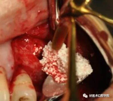 一文读懂与上颌窦提升术相关的上颌窦囊性病变!