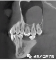 一文读懂与上颌窦提升术相关的上颌窦囊性病变!