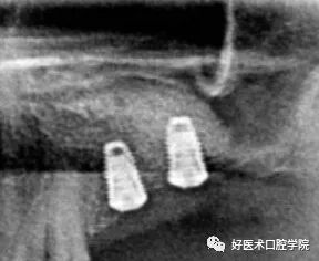一文读懂与上颌窦提升术相关的上颌窦囊性病变!