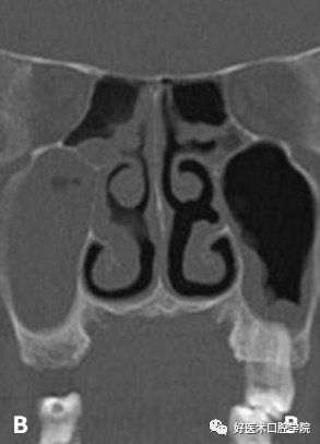 一文读懂与上颌窦提升术相关的上颌窦囊性病变!