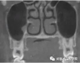 一文读懂与上颌窦提升术相关的上颌窦囊性病变!