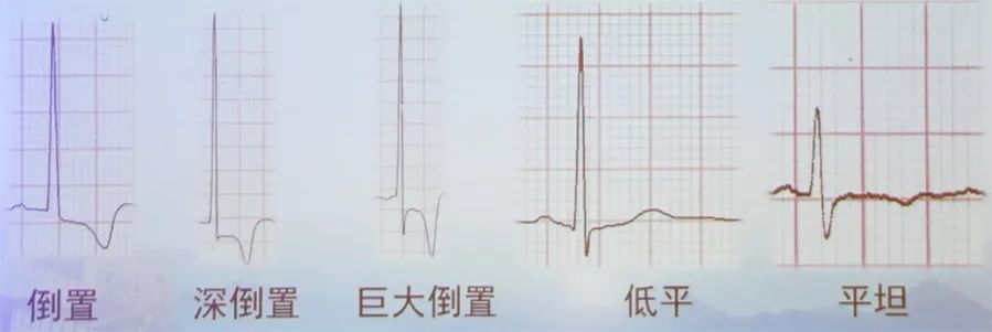 多变的T波,如何鉴别及危险分层? - 好医术文章 - 好医术-赋能医生守护生命