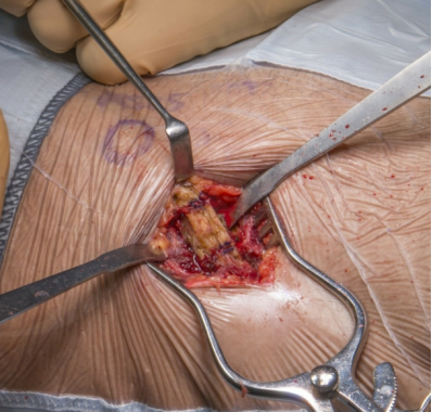 骨科基本技术:成人髂前棘骨移植物获取方法总结