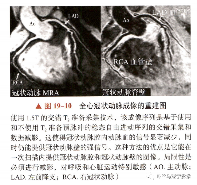 冠状动脉详细解剖,收藏级!