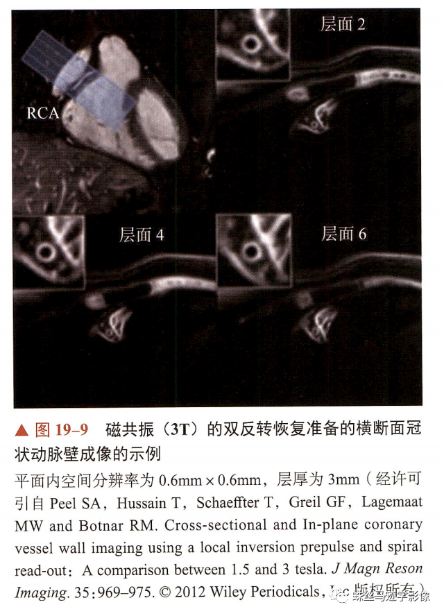 冠状动脉详细解剖,收藏级!