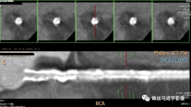 冠状动脉详细解剖,收藏级!