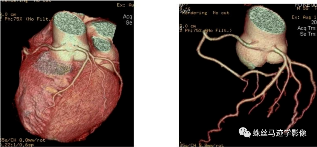冠状动脉详细解剖,收藏级!
