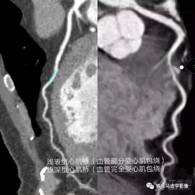 冠状动脉详细解剖,收藏级!