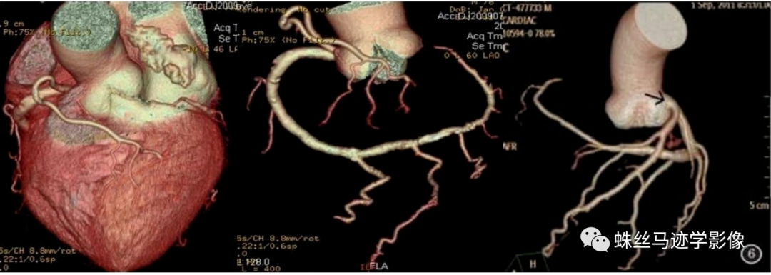 冠状动脉详细解剖,收藏级!