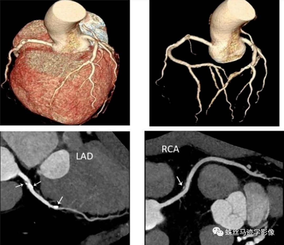 冠状动脉详细解剖,收藏级!
