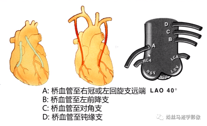 冠状动脉详细解剖,收藏级!