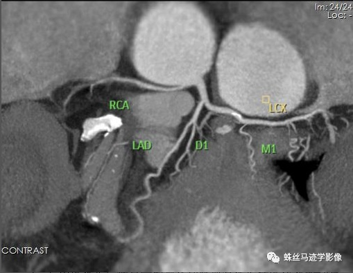冠状动脉详细解剖,收藏级!