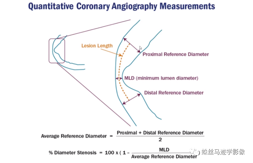 冠状动脉详细解剖,收藏级!