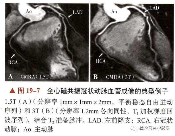 冠状动脉详细解剖,收藏级!