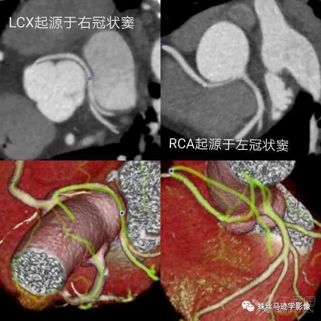 冠状动脉详细解剖,收藏级!