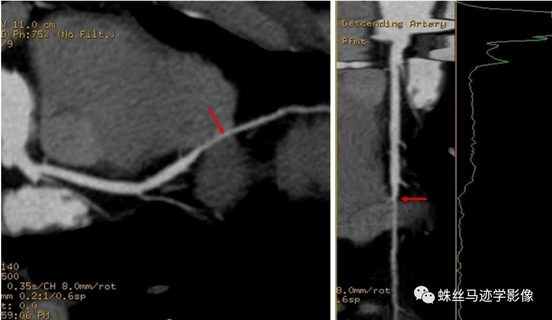 冠状动脉详细解剖,收藏级!