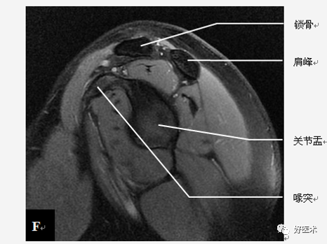 高清影像图解肩关节解剖及诊断
