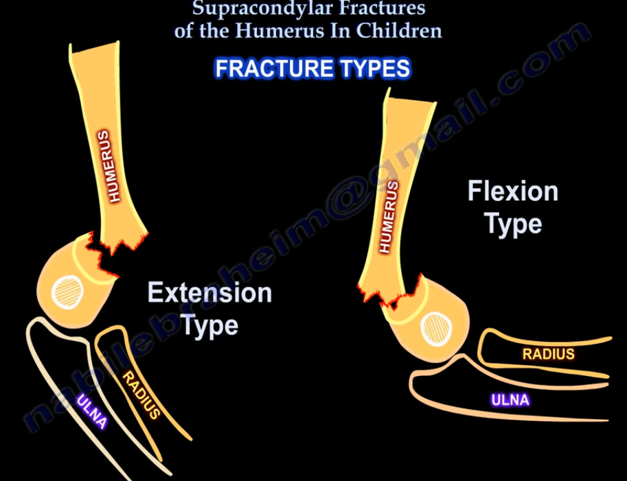 致命的“内侧针”:儿童肱骨髁上骨折术后新发尺神经损伤,立即拔针就对了吗?