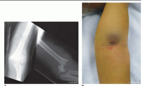 致命的“内侧针”:儿童肱骨髁上骨折术后新发尺神经损伤,立即拔针就对了吗?