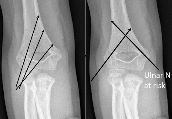 致命的“内侧针”:儿童肱骨髁上骨折术后新发尺神经损伤,立即拔针就对了吗?