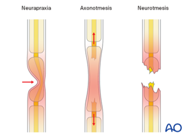 致命的“内侧针”:儿童肱骨髁上骨折术后新发尺神经损伤,立即拔针就对了吗?