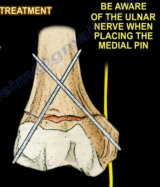 致命的“内侧针”:儿童肱骨髁上骨折术后新发尺神经损伤,立即拔针就对了吗?