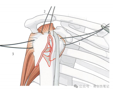 肱骨近端骨折的复位与固定技术AO版