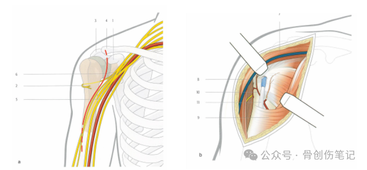 肱骨近端骨折的复位与固定技术AO版