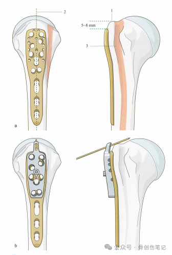 肱骨近端骨折的复位与固定技术AO版