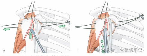 肱骨近端骨折的复位与固定技术AO版