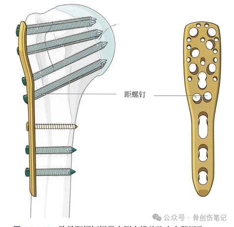 肱骨近端骨折的复位与固定技术AO版