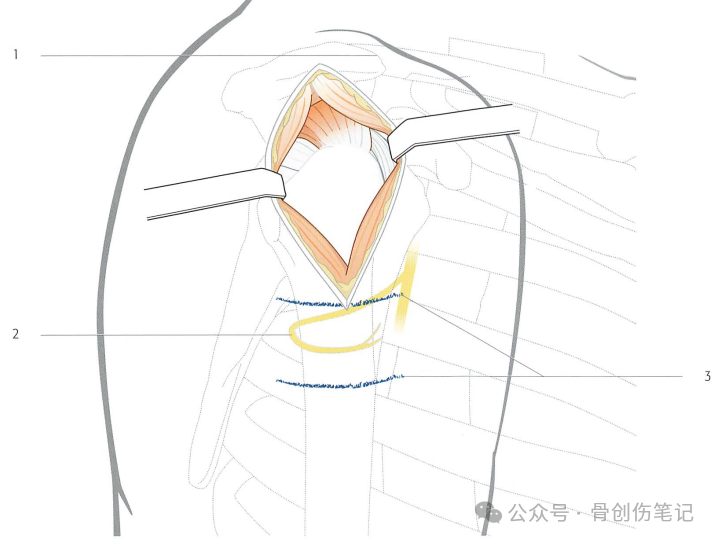 肱骨近端骨折的复位与固定技术AO版
