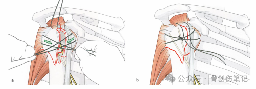 肱骨近端骨折的复位与固定技术AO版