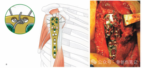 肱骨近端骨折的复位与固定技术AO版