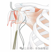 肱骨近端骨折的复位与固定技术AO版