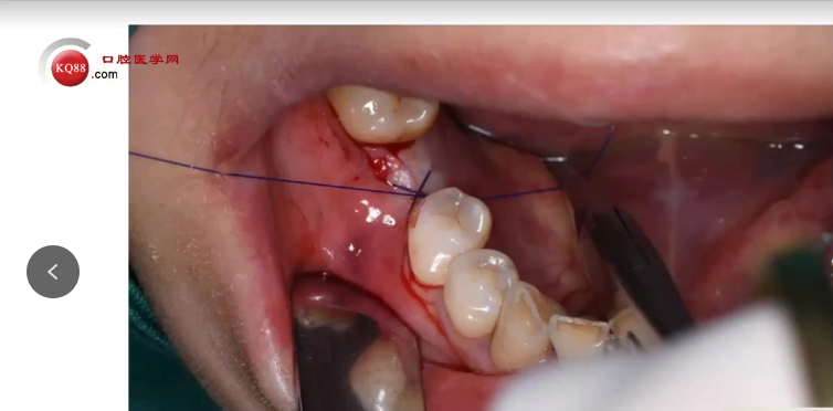 种植医生必看:掌握骨结合与种植体选择的临床关键点