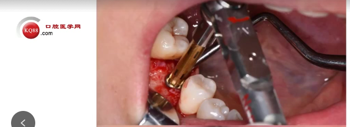 种植医生必看:掌握骨结合与种植体选择的临床关键点