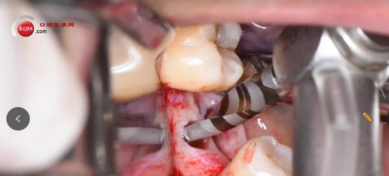 种植医生必看:掌握骨结合与种植体选择的临床关键点