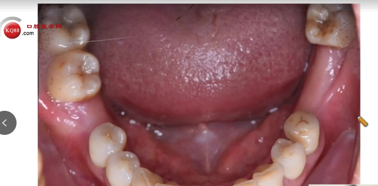 种植医生必看:掌握骨结合与种植体选择的临床关键点