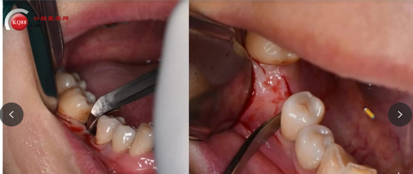 种植医生必看:掌握骨结合与种植体选择的临床关键点