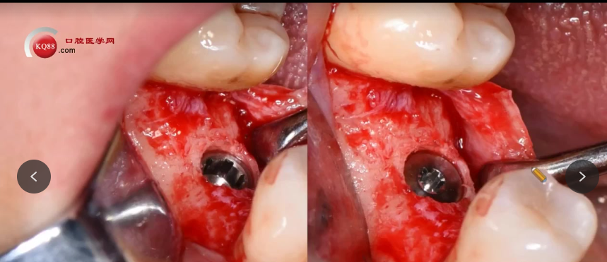 种植医生必看:掌握骨结合与种植体选择的临床关键点