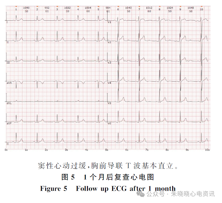 年轻患者Wellens综合征的T波动态演变
