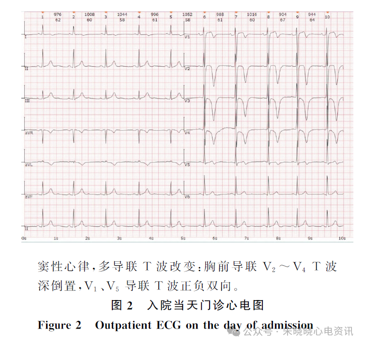 年轻患者Wellens综合征的T波动态演变