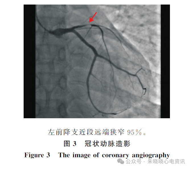 年轻患者Wellens综合征的T波动态演变