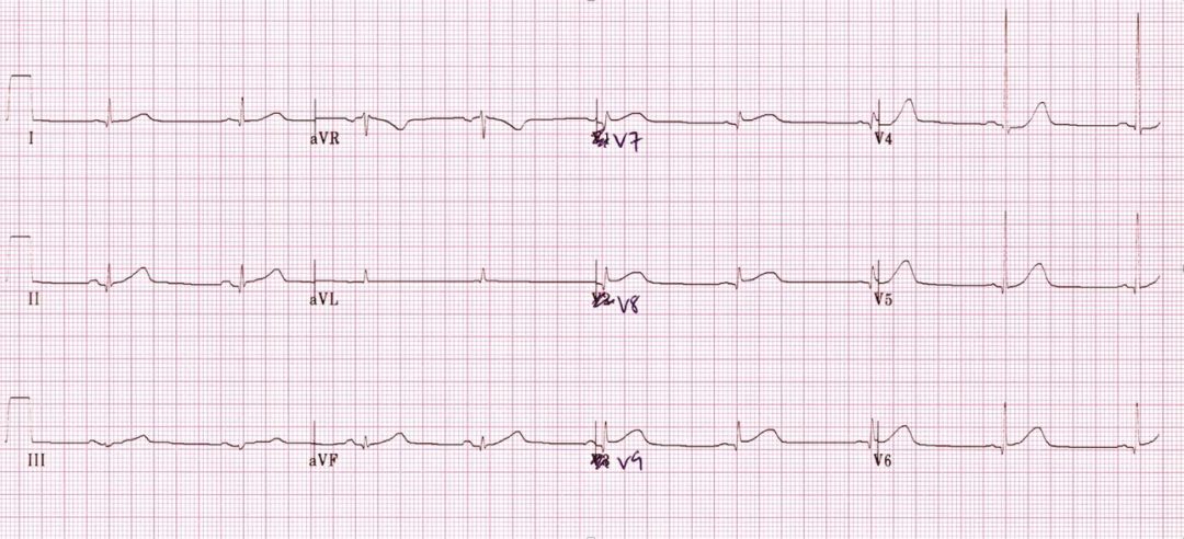 12导、15导、18导连接示意图及心脏各壁超声解剖位置与心电图导联对应关系