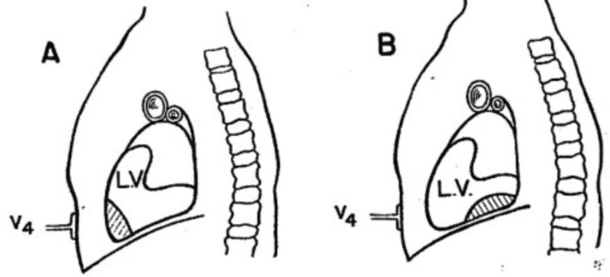 12导、15导、18导连接示意图及心脏各壁超声解剖位置与心电图导联对应关系