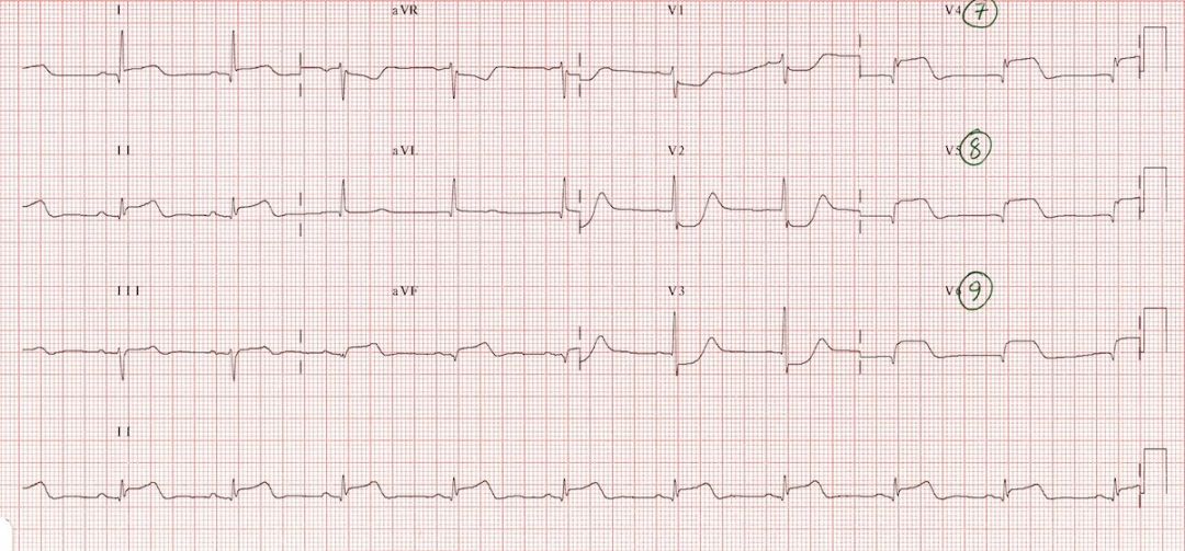 12导、15导、18导连接示意图及心脏各壁超声解剖位置与心电图导联对应关系