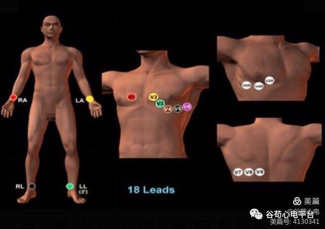 12导、15导、18导连接示意图及心脏各壁超声解剖位置与心电图导联对应关系